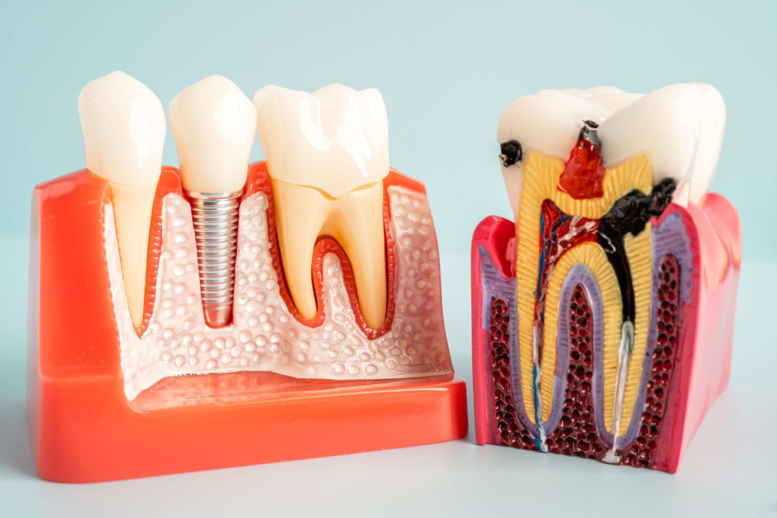 Tratamentul Periimplantar