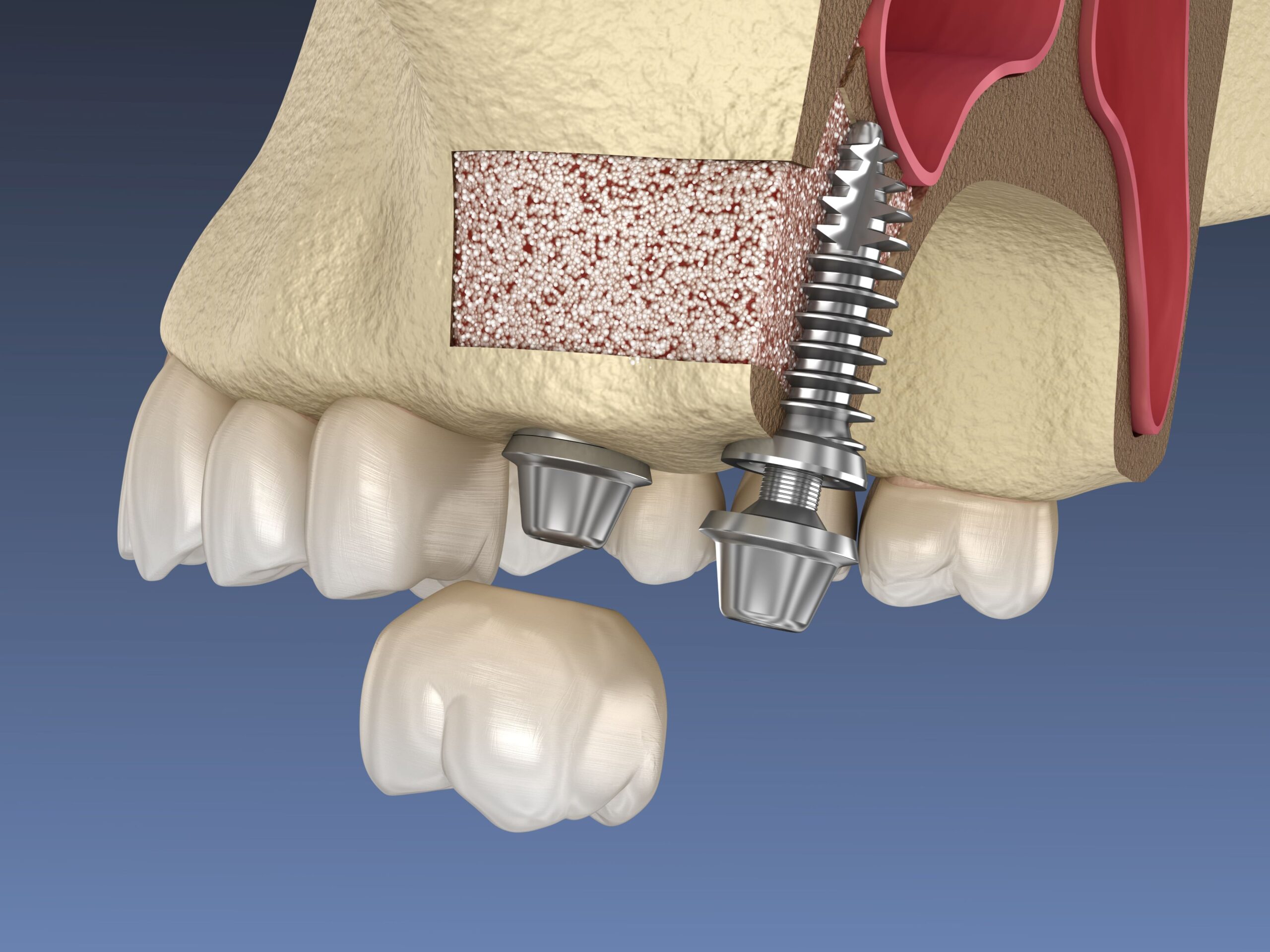 Sinus Lifting