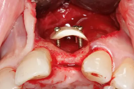 Bone Augumentation  4