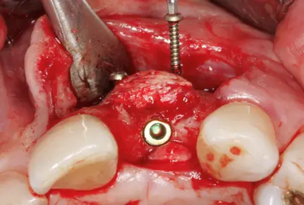 Bone Augumentation  5