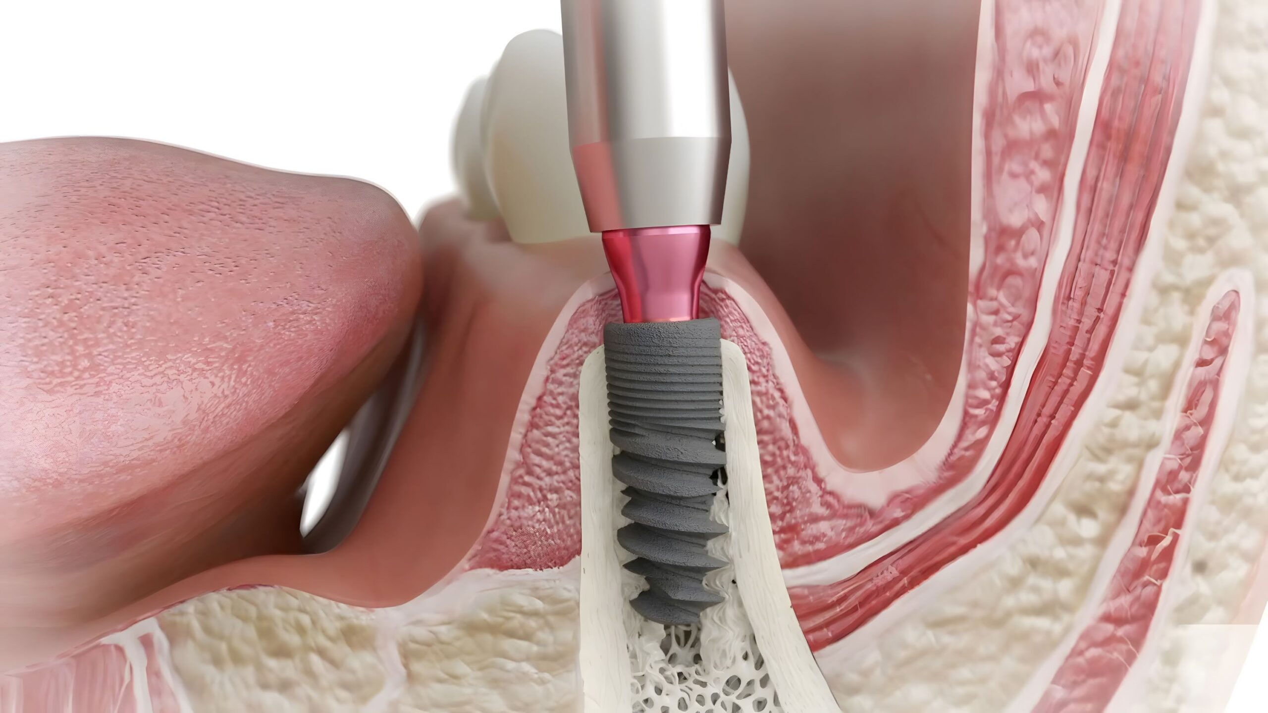 Osteointegrarea Implantului Dentar