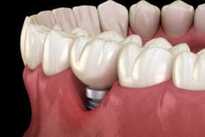 Peri Implantitis,With,Visible,Gum,Recession.,Medically,Accurate,3d,Illustration,Of