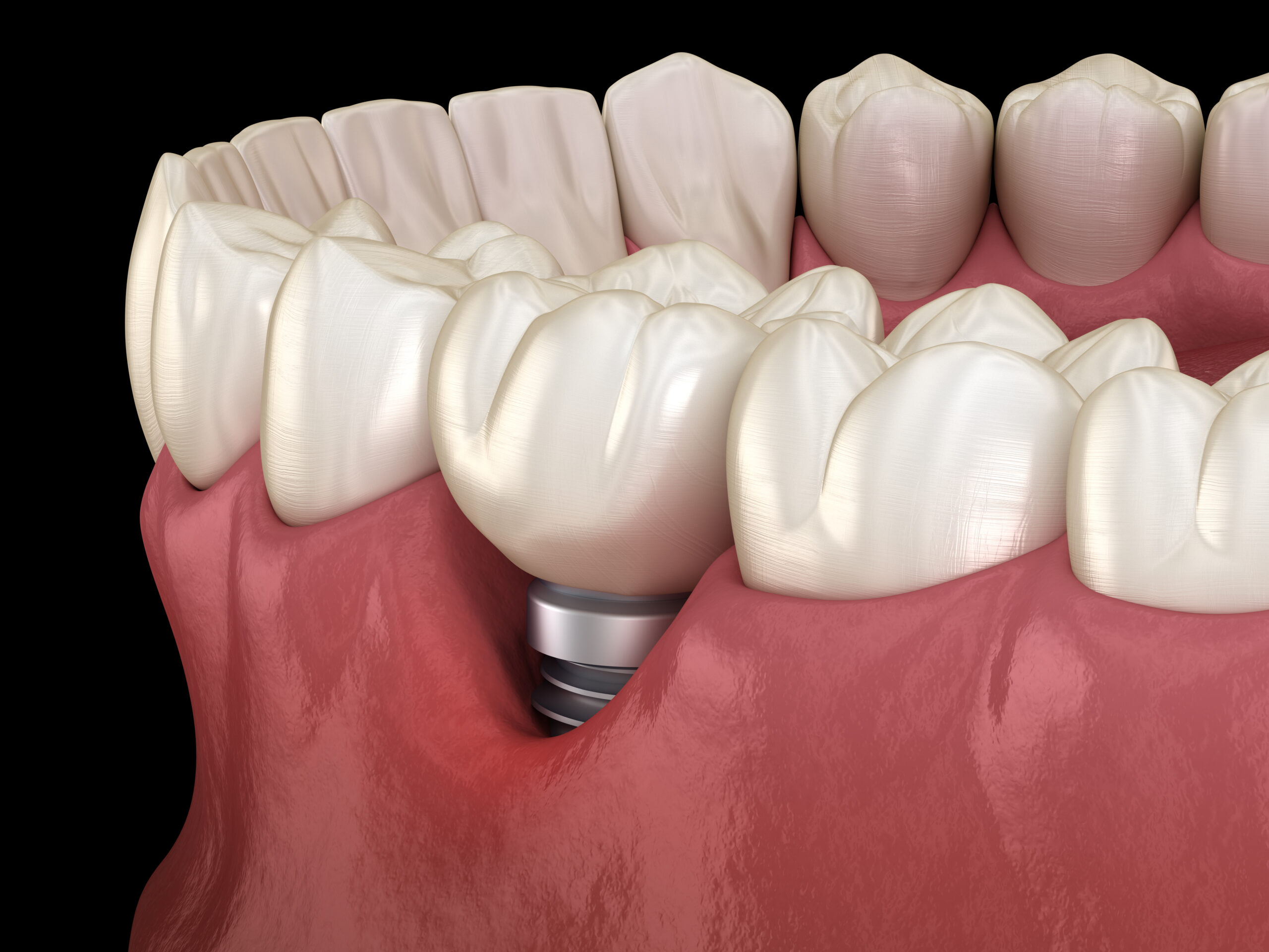 Peri Implantitis,With,Visible,Gum,Recession.,Medically,Accurate,3d,Illustration,Of