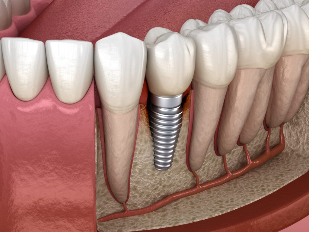 Periimplantitis,With,Visible,Bone,Damage.,Medically,Accurate,3d,Illustration