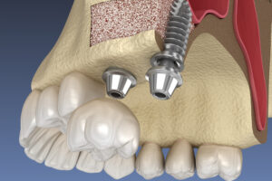 sinus-lift-implanturi-dentare