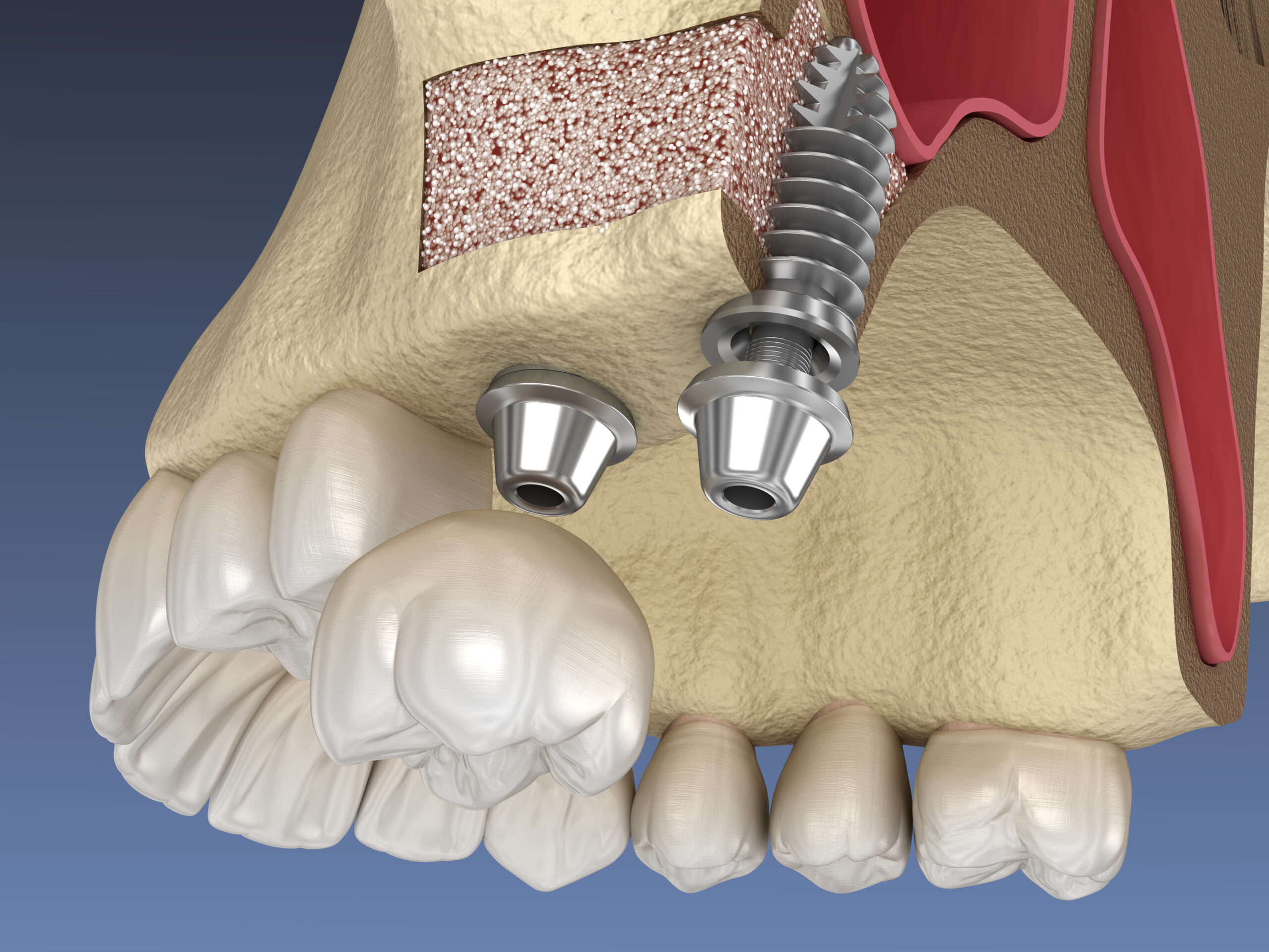 sinus-lift-implanturi-dentare