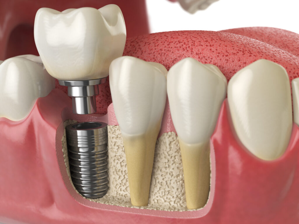 osteodensificare-implant-dentar