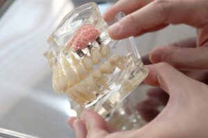 osteodensificare-implant-dentar