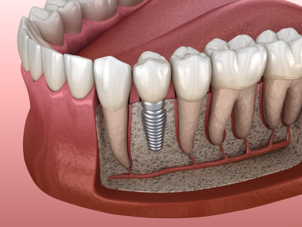 prf-implant-dentar