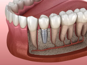 prf-implant-dentar