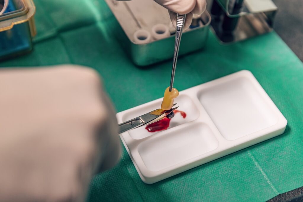 Prf,Platelet,Rich,Fibrin,Therapy,Allows,Patients,To,Take,Advantage