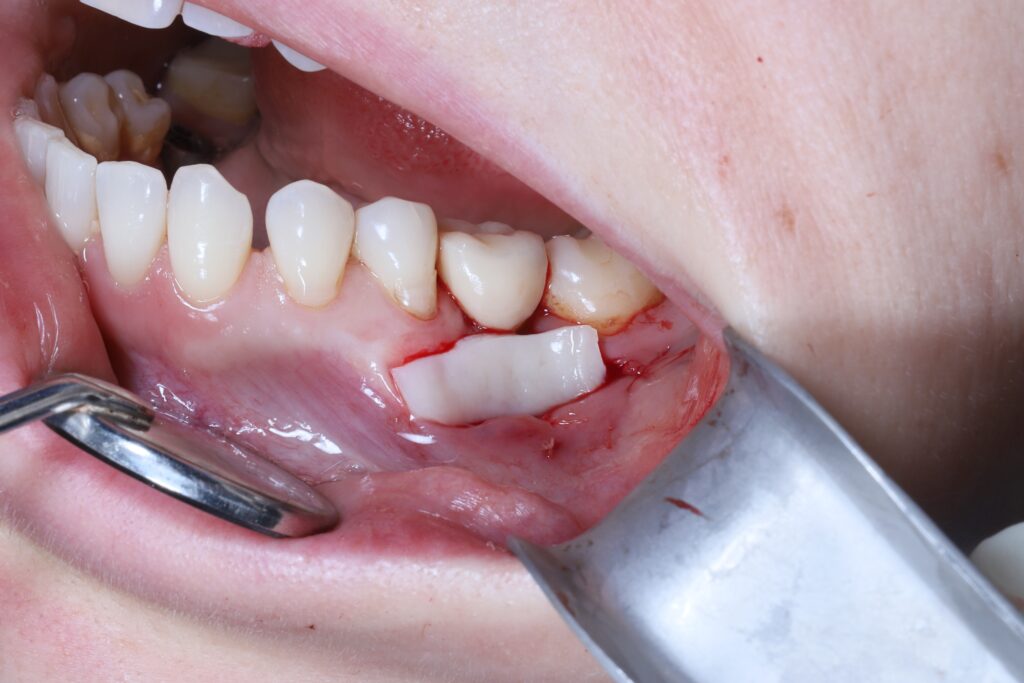 recesiunea-gingivala
