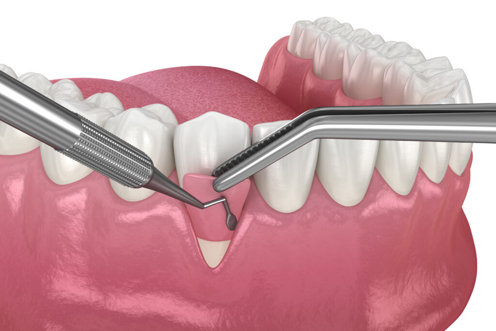 recesiunea-gingivala