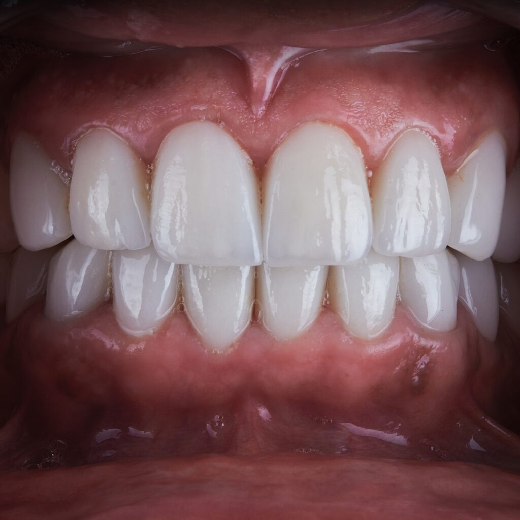 rolul-biotipului-gingival