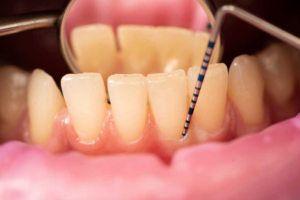 rolul-biotipului-gingival