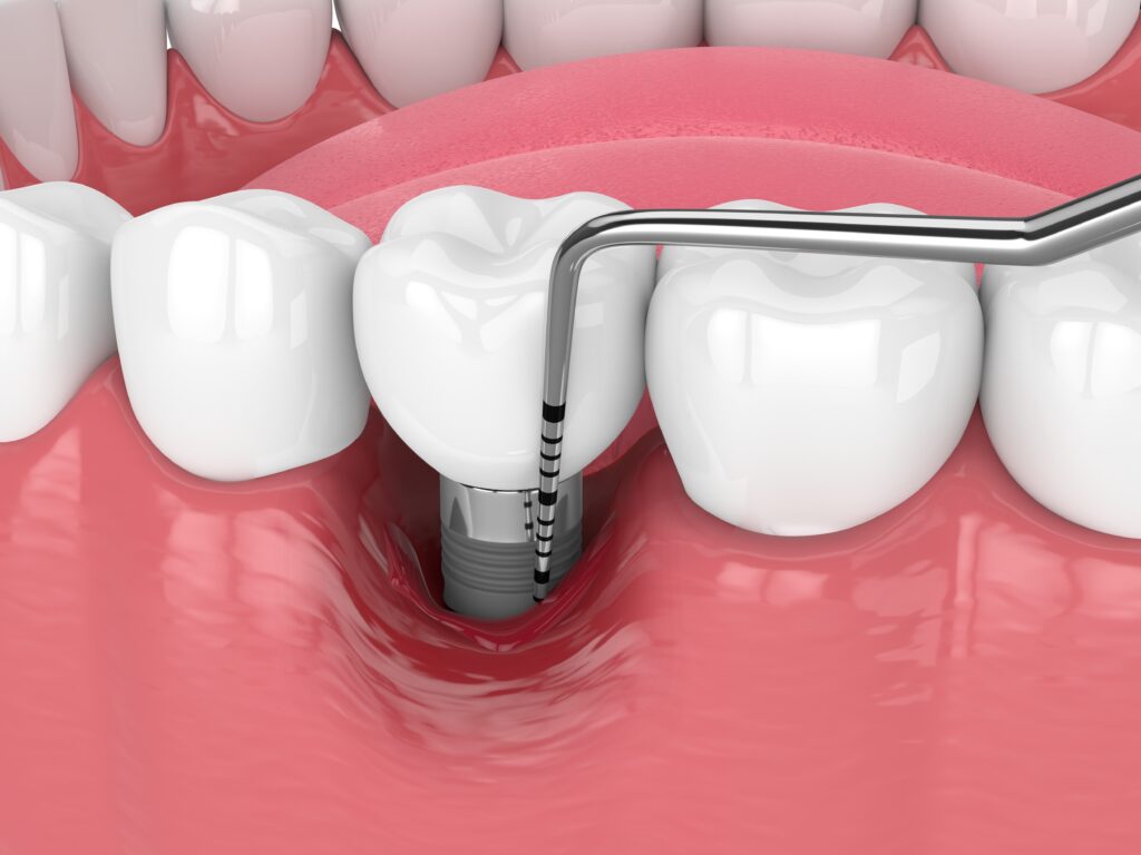 periimplantita