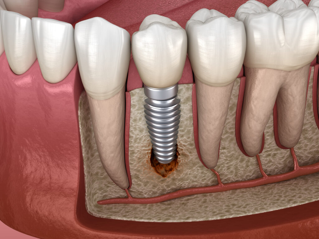 periimplantita