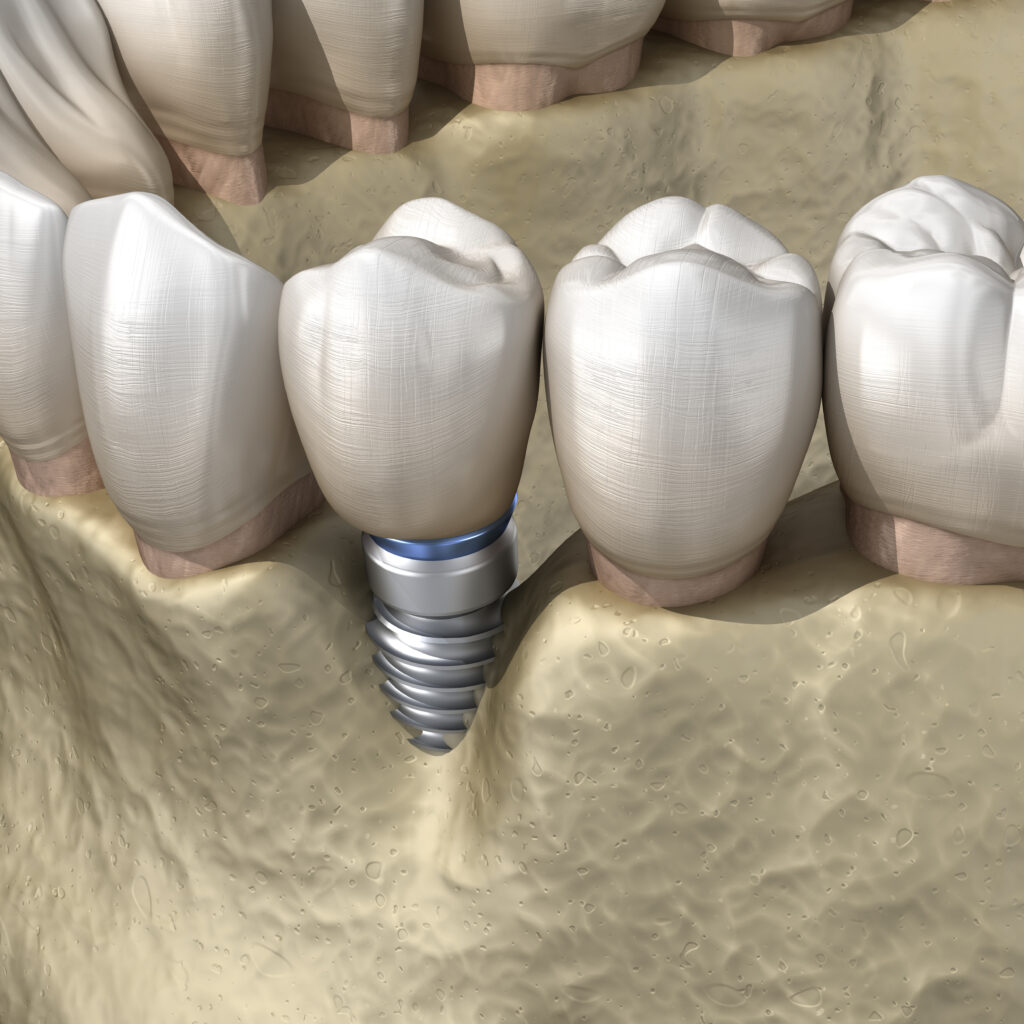 periimplantita