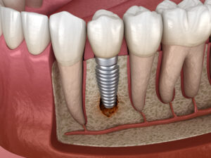 periimplantita