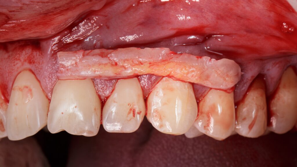 vip-ct-graft
