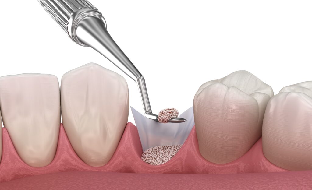 augmentare-grefa-dentinara