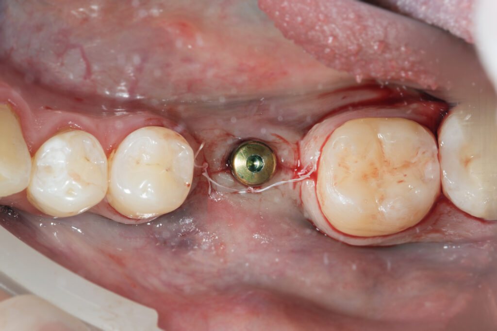 augmentare-tesut-keratinizat