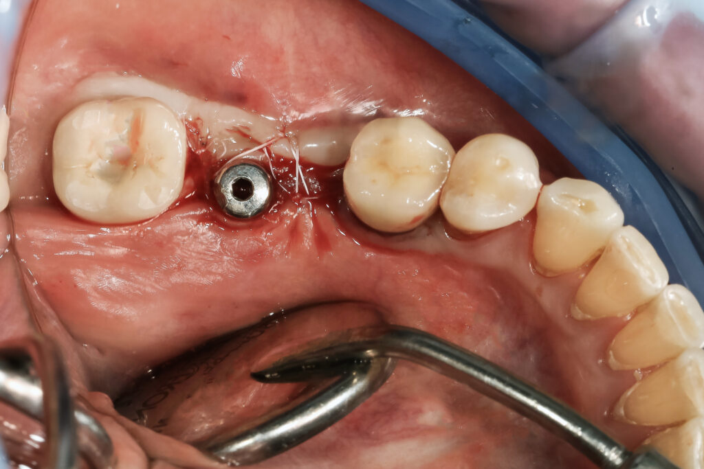augmentare-tesut-keratinizat