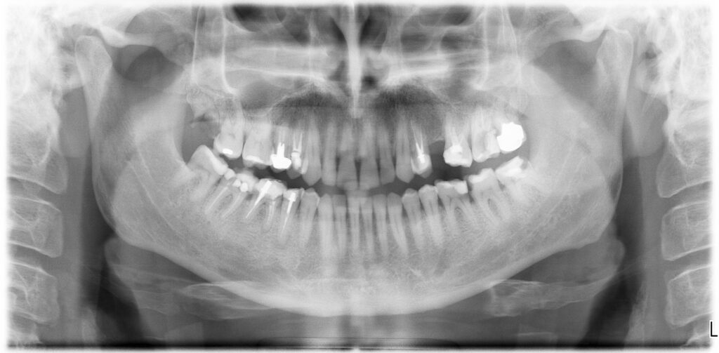 grefa-dentinara