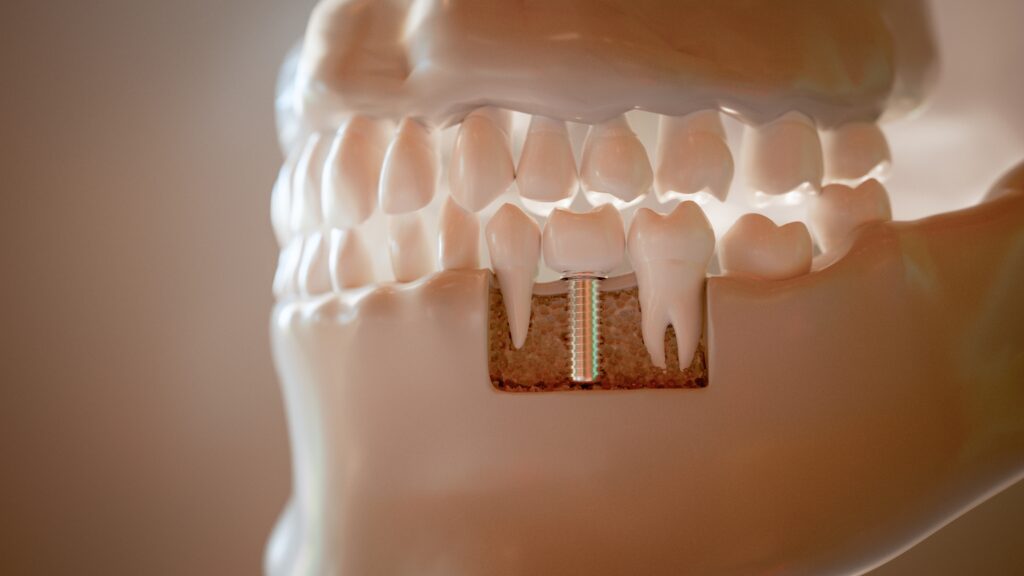 incarcarea-imediata-Orthodontic-Socket Preservation