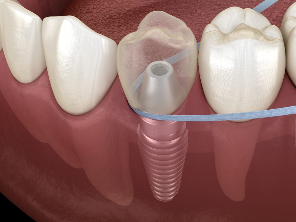 incarcarea-imediata-Orthodontic-Socket Preservation