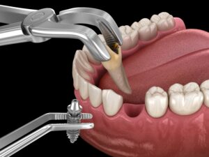 incarcarea-imediata-Orthodontic-Socket Preservation