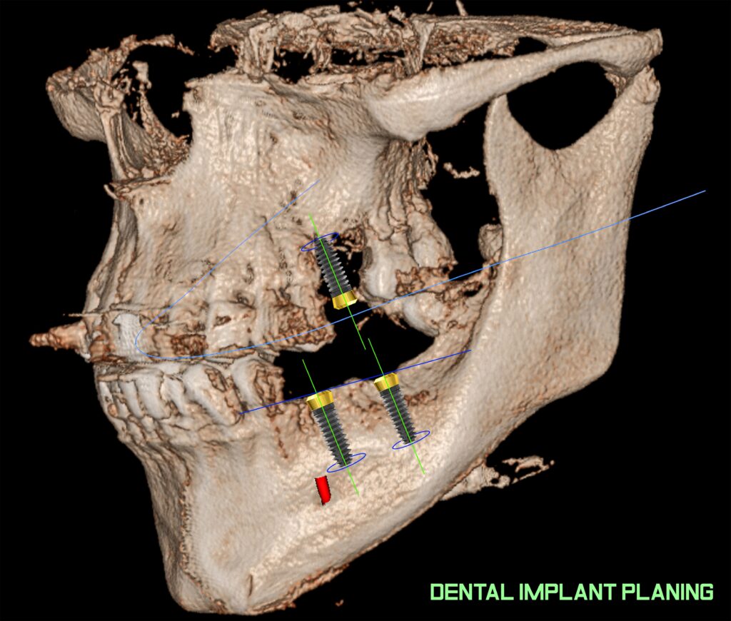 incarcarea-imediata-Orthodontic-Socket Preservation