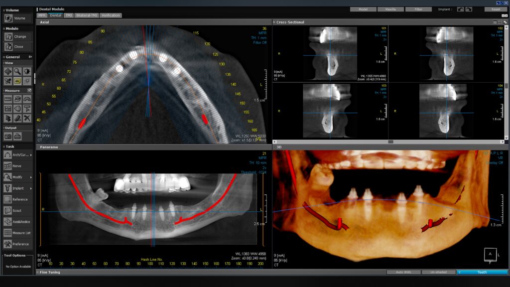 reabilitare-orala-parodontita