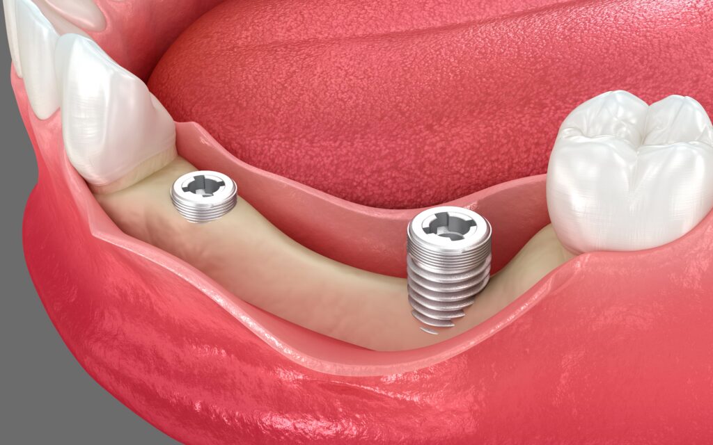 regenerarea-osoasă-ghidată