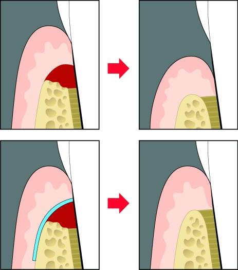 tratamentul-regenerativ-parodontal