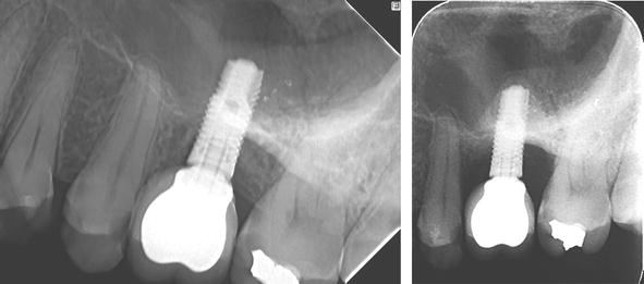 protetica-pe-implanturi