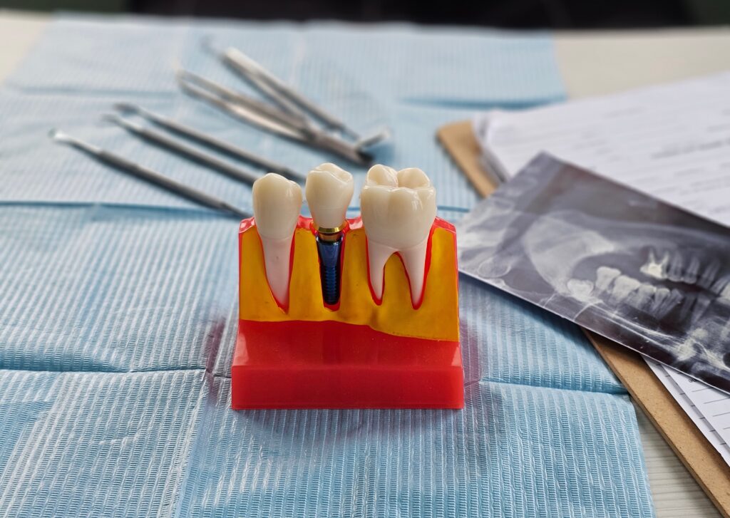 protetica-pe-implanturi