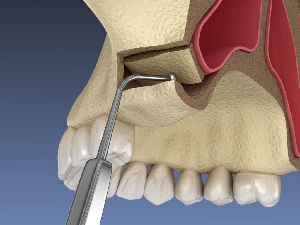 sinus-lift