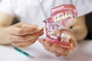 medic exemplifica restaurarea dentara folosind un model de arcade cu implanturi inserate
