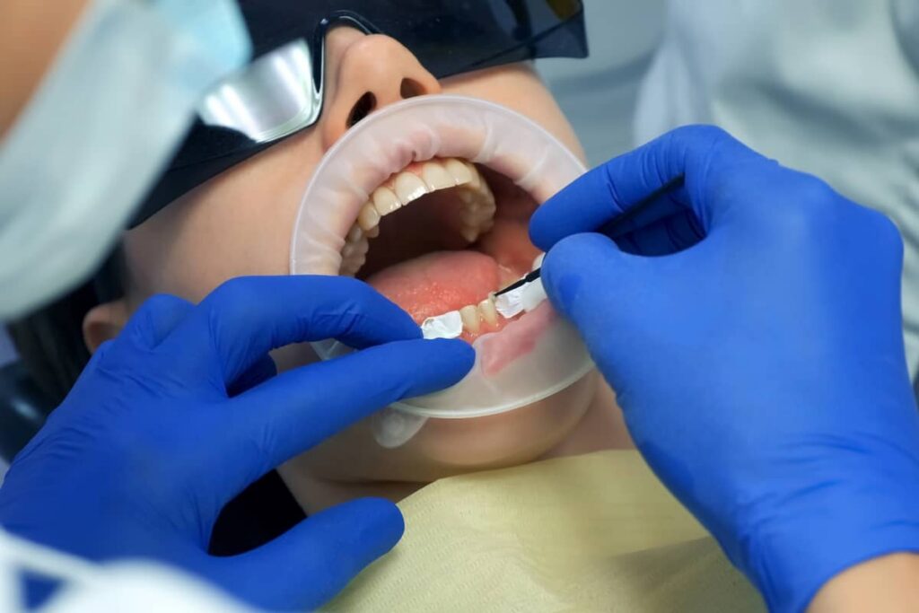 stomatolog si pacient in timpul procedurii de preparare a dintilor pentru aplicarea fatetelor dentare