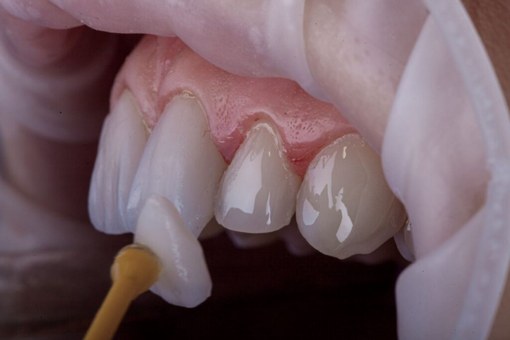 aplicare-fatete-dentare